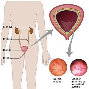 膀胱炎有哪些症状表示